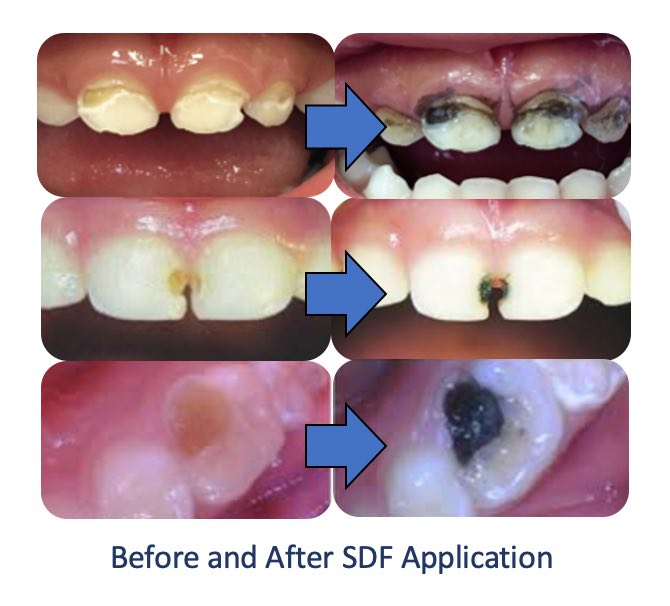 sdf-before-and-after