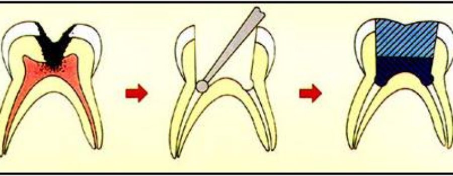 nerve-pulp-therapy